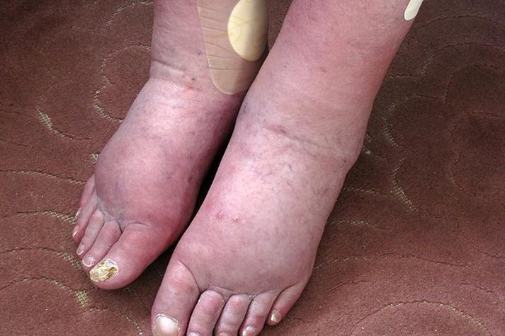 孕期下肢静脉血栓会有哪些典型症状?如何与正常孕期水肿区分?-第1张图片-郑州医学网 孕期下肢静脉血栓会有哪些典型症状?如何与正常孕期水肿区分?-第1张图片-郑州医学网