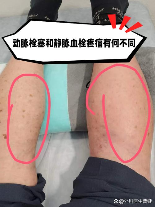 孕期下肢静脉血栓会有哪些典型症状?如何与正常孕期水肿区分?-第2张图片-郑州医学网 孕期下肢静脉血栓会有哪些典型症状?如何与正常孕期水肿区分?-第2张图片-郑州医学网