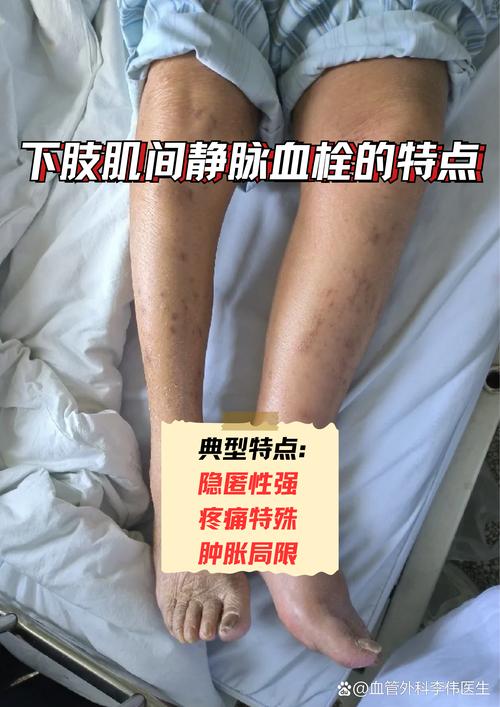 孕期下肢静脉血栓会有哪些典型症状?如何与正常孕期水肿区分?-第3张图片-郑州医学网 孕期下肢静脉血栓会有哪些典型症状?如何与正常孕期水肿区分?-第3张图片-郑州医学网