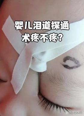 新生儿泪道探通术视频全过程安全吗？家长观看前需了解哪些注意事项？-第1张图片-郑州医学网