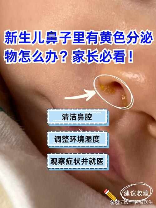 新生儿鼻腔为何总是鼻屎堆积?是生理结构特殊还是护理不当导致的?-第1张图片-郑州医学网 新生儿鼻腔为何总是鼻屎堆积?是生理结构特殊还是护理不当导致的?-第1张图片-郑州医学网