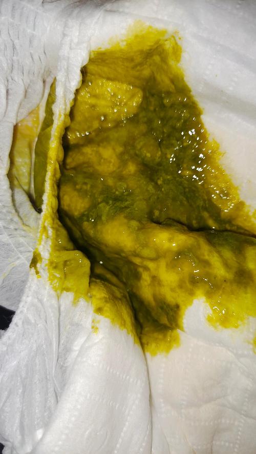 新生儿拉屎有奶瓣还发绿,是消化不良还是需要就医?-第1张图片-郑州医学网 新生儿拉屎有奶瓣还发绿,是消化不良还是需要就医?-第1张图片-郑州医学网