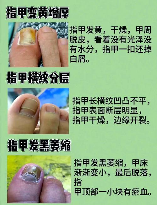 孕期灰指甲会影响胎儿健康吗?有哪些安全有效的治疗方法?-第1张图片-郑州医学网 孕期灰指甲会影响胎儿健康吗?有哪些安全有效的治疗方法?-第1张图片-郑州医学网