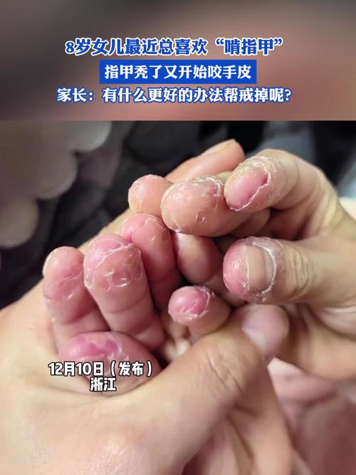 儿童咬指甲是习惯问题还是心理信号？家长该如何科学应对？-第2张图片-郑州医学网