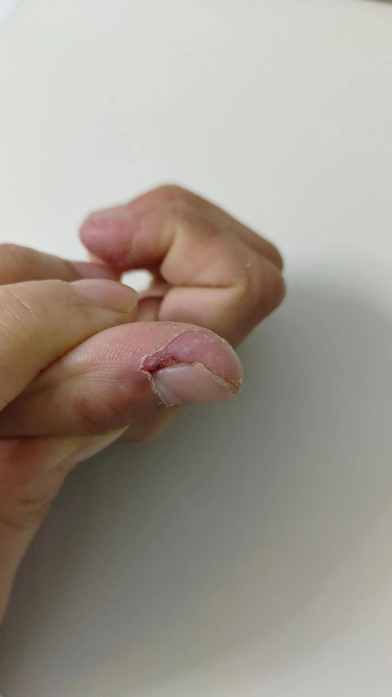 儿童咬指甲是习惯问题还是心理信号？家长该如何科学应对？-第3张图片-郑州医学网