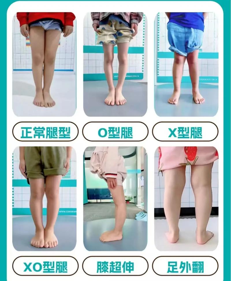儿童腿型矫正的黄金年龄是几岁？错过会影响发育吗？-第2张图片-郑州医学网