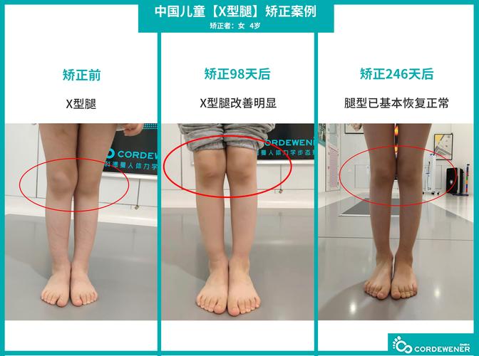 儿童腿型矫正的黄金年龄是几岁？错过会影响发育吗？-第1张图片-郑州医学网