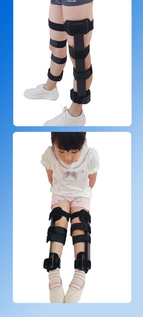 儿童腿型矫正的黄金年龄是几岁？错过会影响发育吗？-第3张图片-郑州医学网