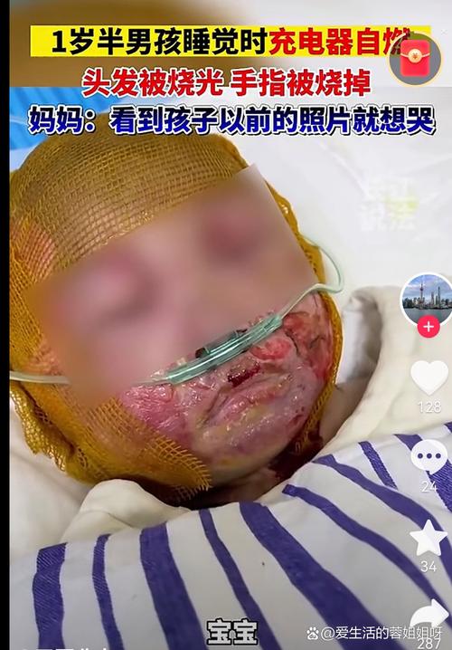 新生儿头被手机砸伤图片引热议，家长该警惕哪些日常安全隐患？-第1张图片-郑州医学网