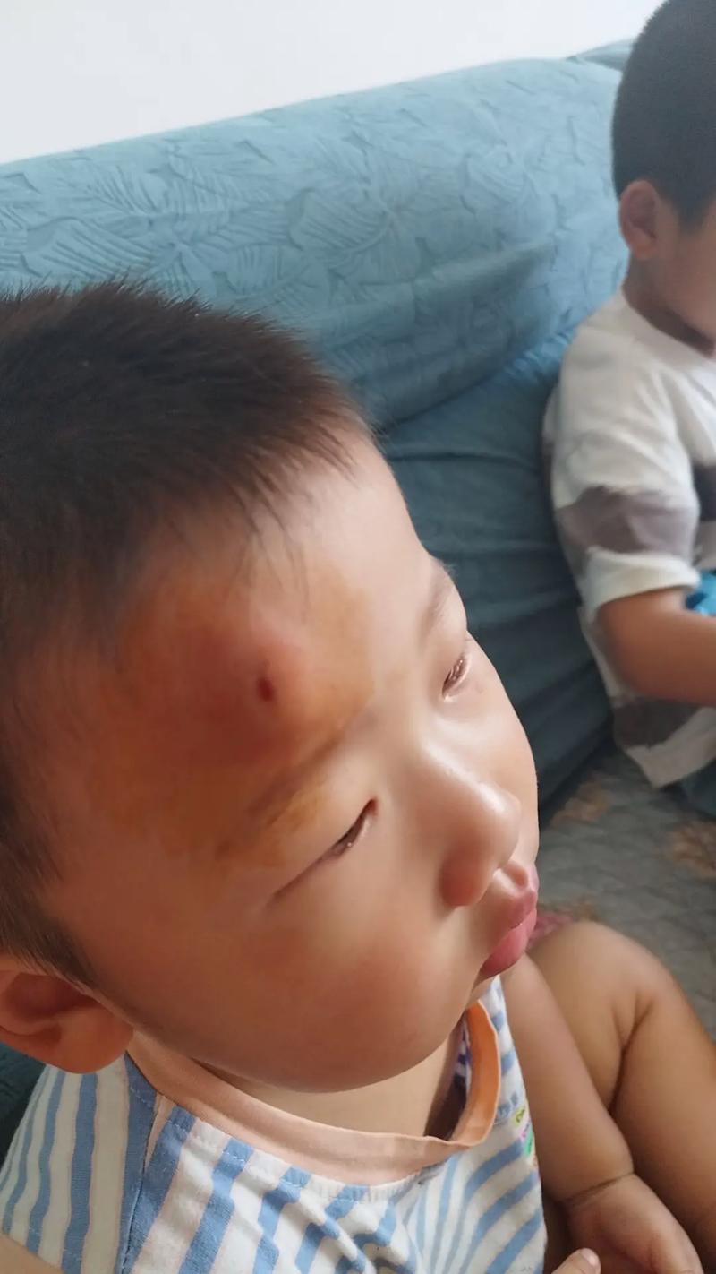 新生儿头被手机砸伤图片引热议，家长该警惕哪些日常安全隐患？-第2张图片-郑州医学网