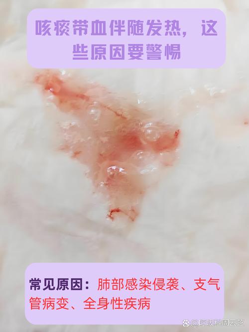 孕期吐痰带血是身体危险信号吗?需警惕哪些孕期并发症?-第1张图片-郑州医学网 孕期吐痰带血是身体危险信号吗?需警惕哪些孕期并发症?-第1张图片-郑州医学网