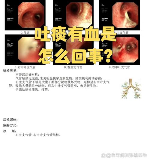 孕期吐痰带血是身体危险信号吗?需警惕哪些孕期并发症?-第2张图片-郑州医学网 孕期吐痰带血是身体危险信号吗?需警惕哪些孕期并发症?-第2张图片-郑州医学网