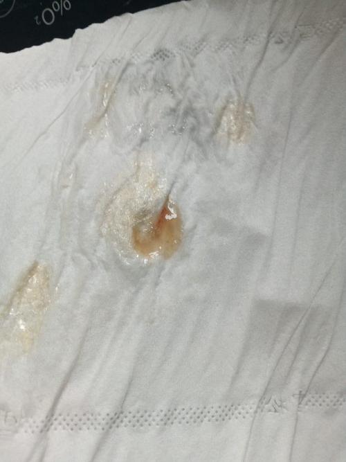 孕期吐痰带血是身体危险信号吗?需警惕哪些孕期并发症?-第3张图片-郑州医学网 孕期吐痰带血是身体危险信号吗?需警惕哪些孕期并发症?-第3张图片-郑州医学网