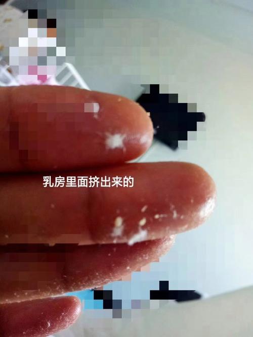 孕期乳头出现白色脂肪粒是什么原因？需要处理吗？-第1张图片-郑州医学网