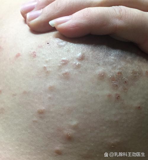 孕期乳头出现白色脂肪粒是什么原因？需要处理吗？-第2张图片-郑州医学网