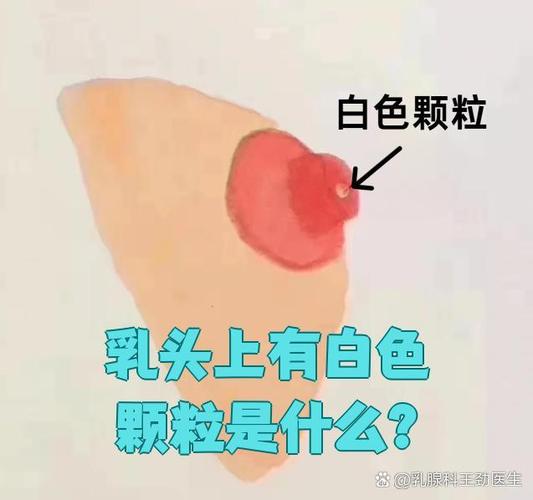 孕期乳头出现白色脂肪粒是什么原因？需要处理吗？-第3张图片-郑州医学网