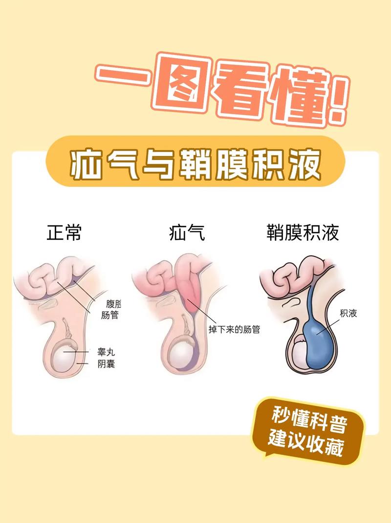 新生儿睾丸鞘膜积液图能直观看到什么？需不需要治疗？-第2张图片-郑州医学网