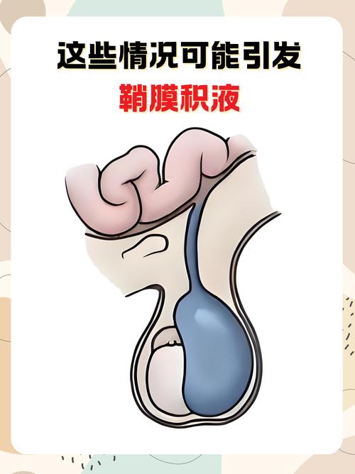 新生儿睾丸鞘膜积液图能直观看到什么？需不需要治疗？-第3张图片-郑州医学网