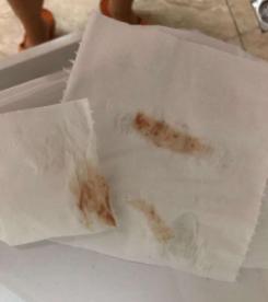 孕期出血后出现褐色分泌物，是正常生理现象还是危险信号？-第1张图片-郑州医学网