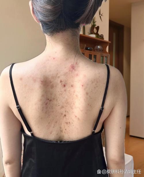 怀孕背后痘痘频发，是激素波动还是身体在报警？-第1张图片-郑州医学网