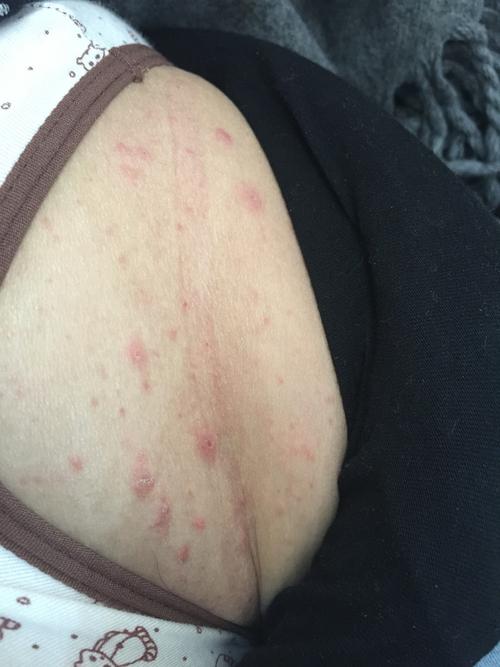 怀孕背后痘痘频发，是激素波动还是身体在报警？-第2张图片-郑州医学网