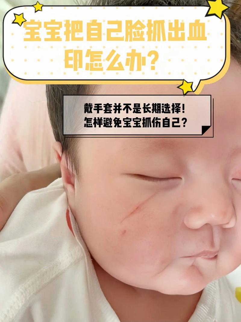 新生儿脸上抓破了怎么办?日常护理与伤口愈合全攻略-第1张图片-郑州医学网 新生儿脸上抓破了怎么办?日常护理与伤口愈合全攻略-第1张图片-郑州医学网