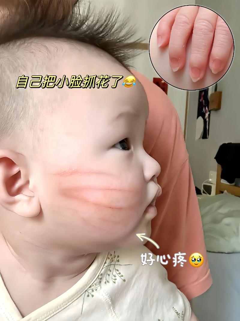 新生儿脸上抓破了怎么办？日常护理与伤口愈合全攻略-第2张图片-郑州医学网