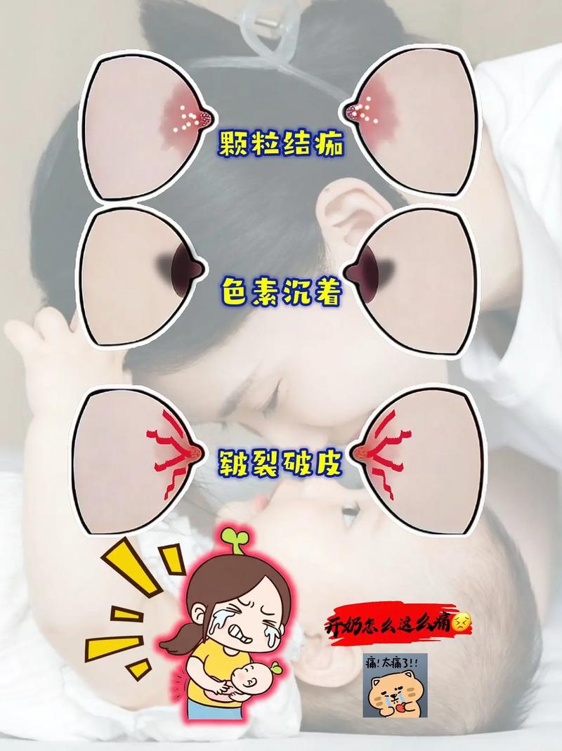 新生儿乳腺炎症状图片有哪些?如何通过图片辨别与护理?-第1张图片-郑州医学网 新生儿乳腺炎症状图片有哪些?如何通过图片辨别与护理?-第1张图片-郑州医学网