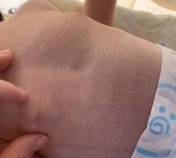 新生儿乳腺炎症状图片有哪些？如何通过图片辨别与护理？-第2张图片-郑州医学网