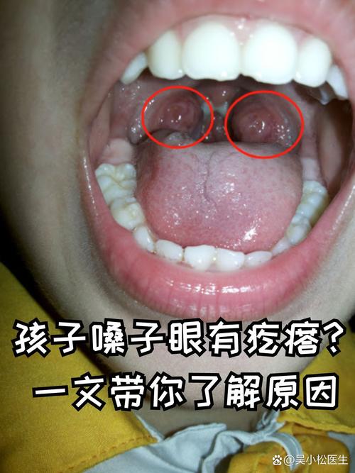 新生儿嗓子发红是上火还是生病？需要家长注意哪些信号？-第2张图片-郑州医学网