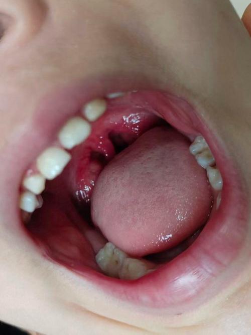 新生儿嗓子发红是上火还是生病?需要家长注意哪些信号?-第3张图片-郑州医学网 新生儿嗓子发红是上火还是生病?需要家长注意哪些信号?-第3张图片-郑州医学网