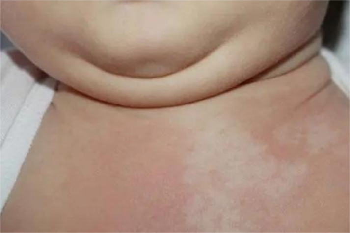 新生儿大理石花纹是疾病信号吗?原因与应对方法全解析-第1张图片-郑州医学网 新生儿大理石花纹是疾病信号吗?原因与应对方法全解析-第1张图片-郑州医学网