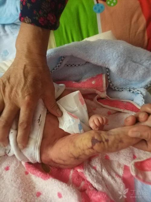 新生儿大理石花纹是疾病信号吗?原因与应对方法全解析-第2张图片-郑州医学网 新生儿大理石花纹是疾病信号吗?原因与应对方法全解析-第2张图片-郑州医学网