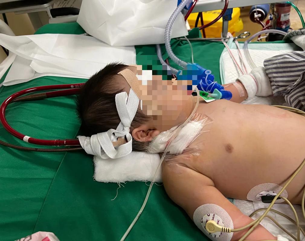 早产儿肺部感染高发，如何精准防治与降低远期风险？-第3张图片-郑州医学网