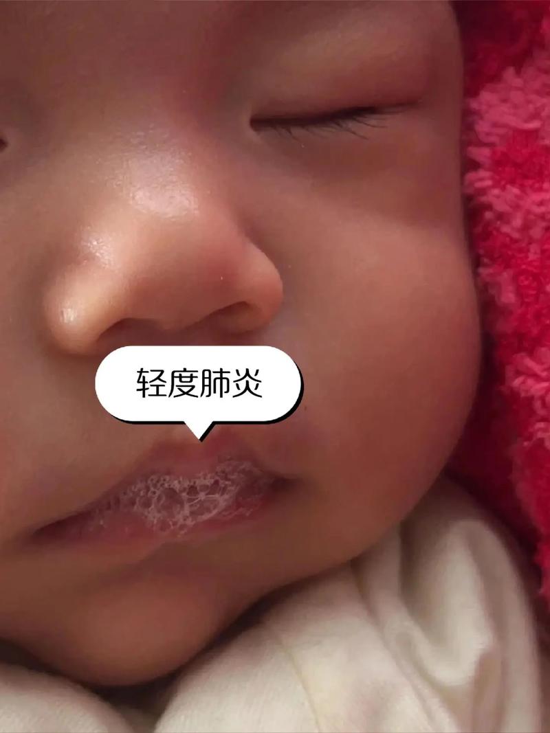 早产儿肺部感染高发,如何精准防治与降低远期风险?-第2张图片-郑州医学网 早产儿肺部感染高发,如何精准防治与降低远期风险?-第2张图片-郑州医学网