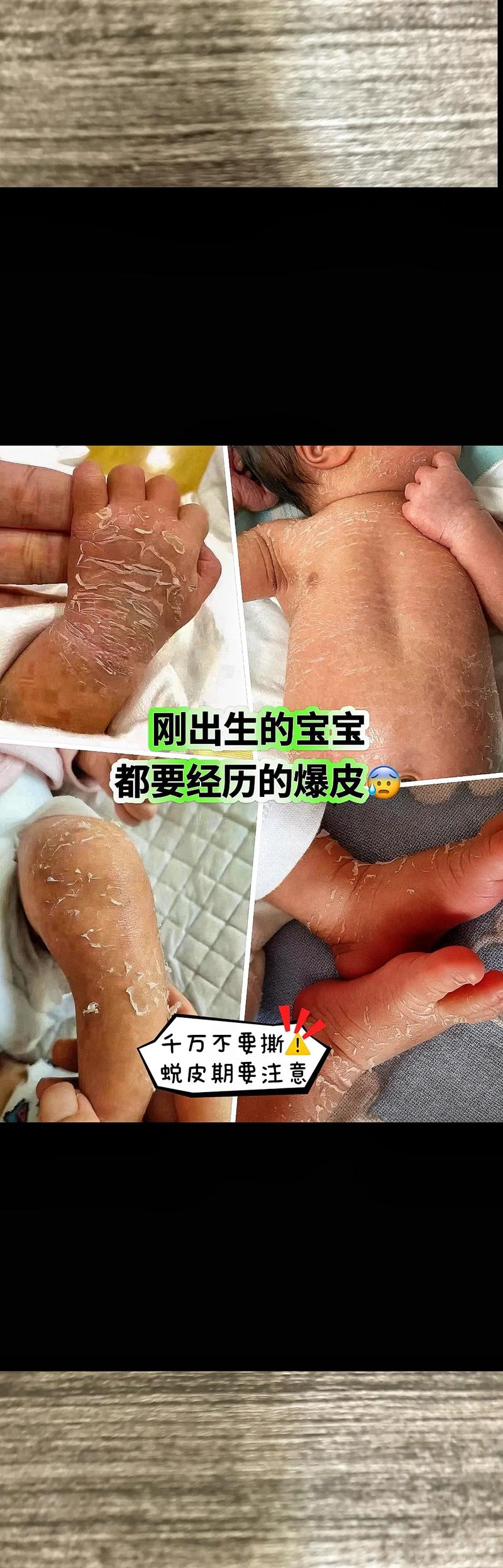 新生儿掉皮是正常生理现象还是皮肤疾病信号？-第3张图片-郑州医学网