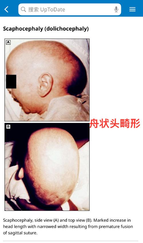 新生儿心门大是什么原因？是否需要治疗？会影响发育吗？-第2张图片-郑州医学网