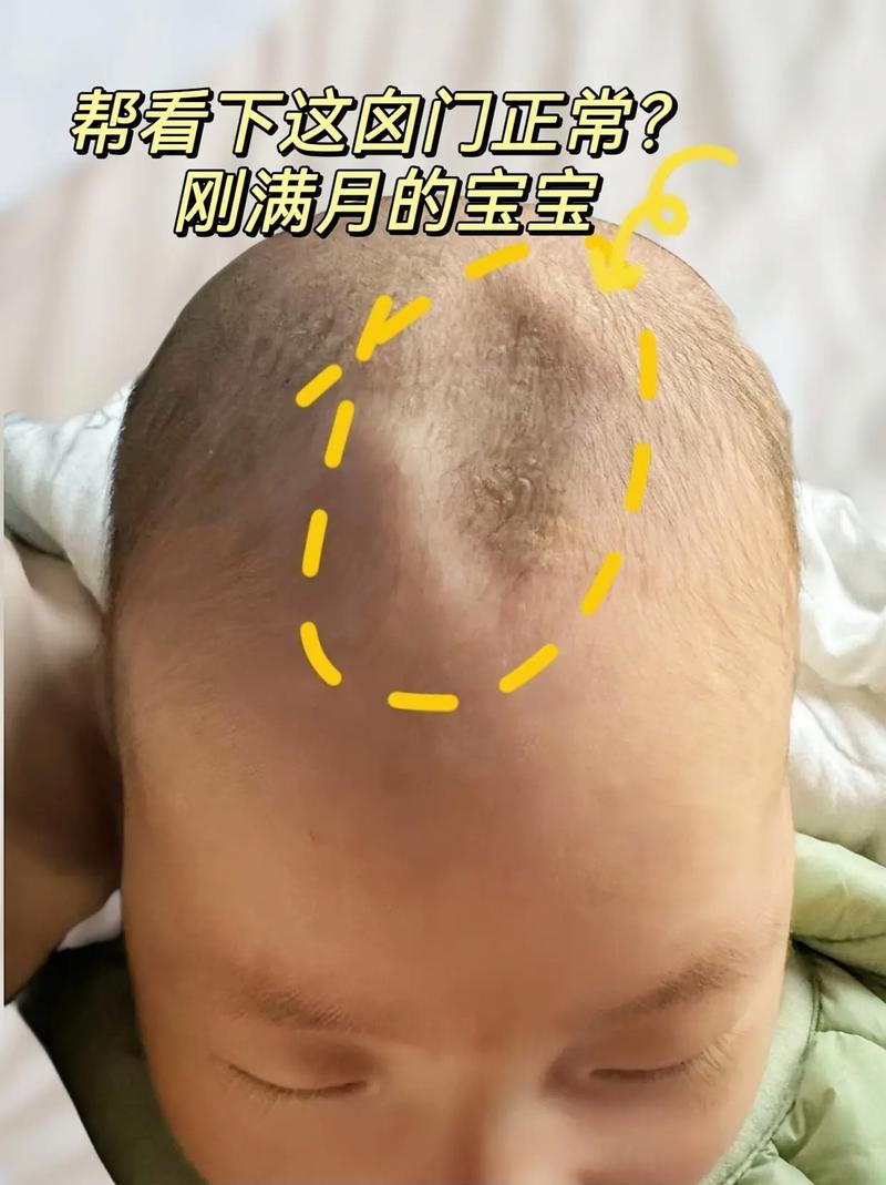 新生儿心门大是什么原因？是否需要治疗？会影响发育吗？-第3张图片-郑州医学网