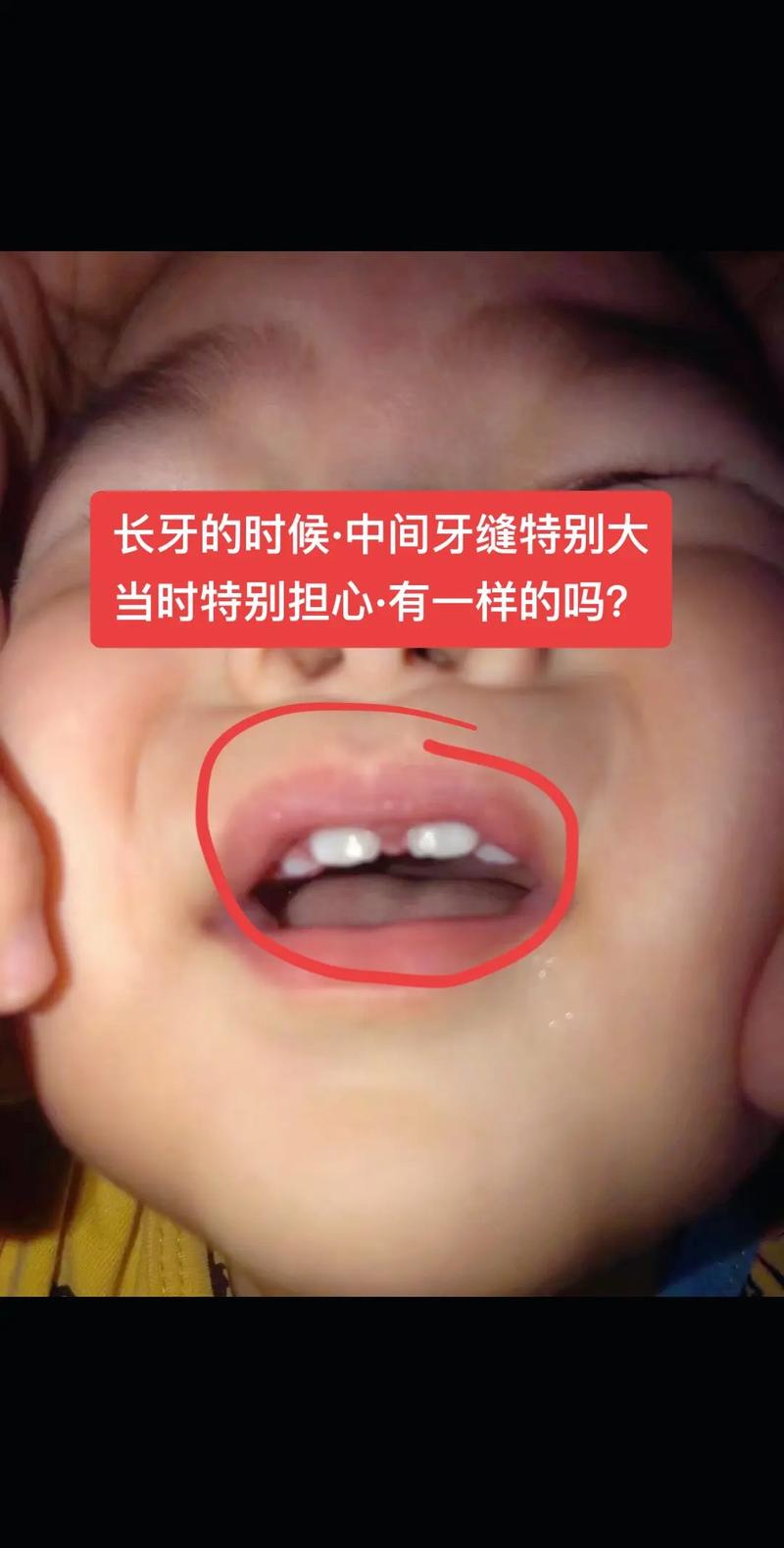 儿童门牙缝隙大是正常现象还是需要干预？如何判断及处理？-第1张图片-郑州医学网