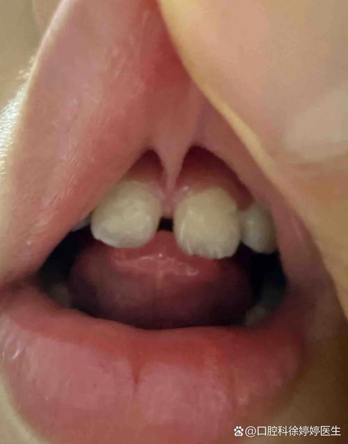 儿童门牙缝隙大是正常现象还是需要干预？如何判断及处理？-第2张图片-郑州医学网