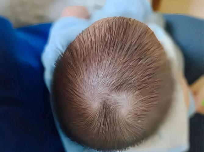 新生儿头顶头发竖起来是缺钙还是正常现象？需要干预吗？-第1张图片-郑州医学网