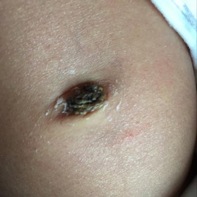 新生儿肚脐未脱落且有脓，是感染还是正常现象？该如何处理？-第3张图片-郑州医学网