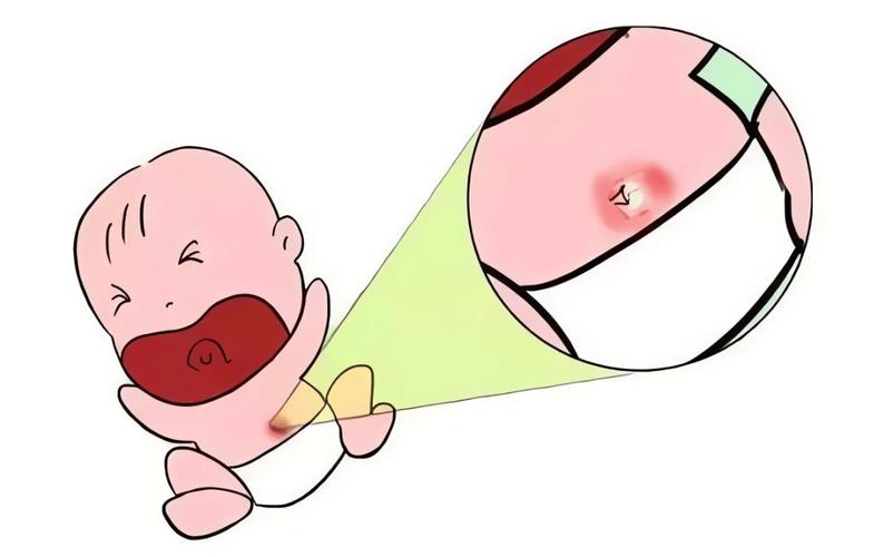 新生儿肚脐分泌物照片正常吗？颜色、性状异常需警惕哪些问题？-第2张图片-郑州医学网