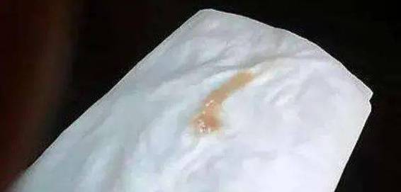 孕期乳头分泌物是正常现象吗？需警惕哪些异常情况？-第2张图片-郑州医学网