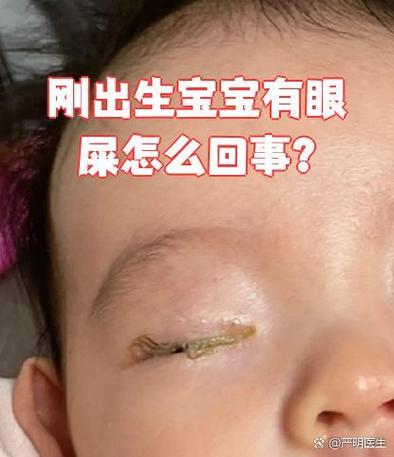 新生儿眼角总出黄眼屎、流泪，是上火还是眼部感染？-第2张图片-郑州医学网