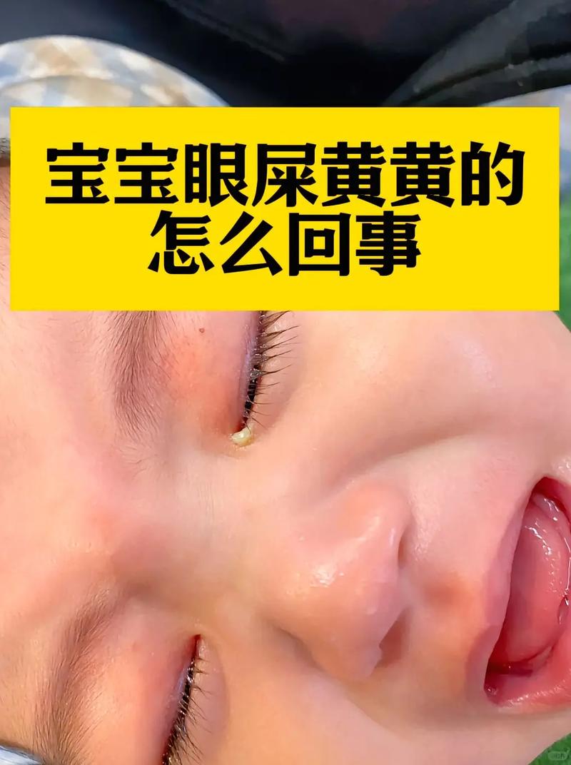 新生儿眼角总出黄眼屎、流泪,是上火还是眼部感染?-第1张图片-郑州医学网 新生儿眼角总出黄眼屎、流泪,是上火还是眼部感染?-第1张图片-郑州医学网