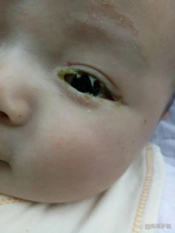 新生儿眼角总出黄眼屎、流泪，是上火还是眼部感染？-第3张图片-郑州医学网