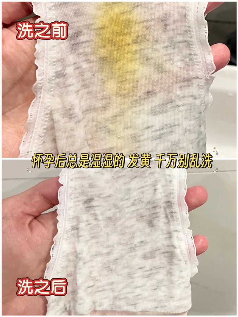 晚孕期白带增多是正常现象还是异常信号?需要警惕哪些疾病风险?-第2张图片-郑州医学网 晚孕期白带增多是正常现象还是异常信号?需要警惕哪些疾病风险?-第2张图片-郑州医学网