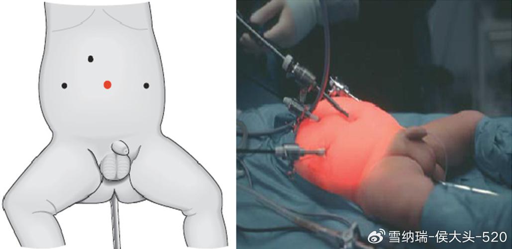 新生儿巨结肠微创手术有哪些关键风险？术后护理要注意什么？-第2张图片-郑州医学网