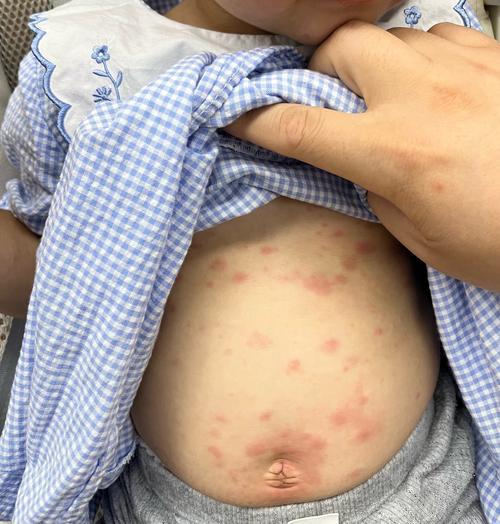 新生儿足跟血苯丙酮高是遗传病吗？需要如何干预治疗？-第2张图片-郑州医学网